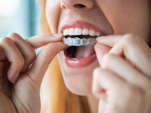 girl putting invisalign in