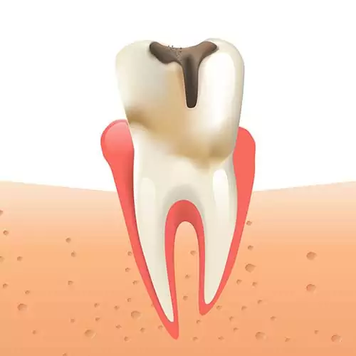 root canal graphic